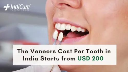 Veneers Cost in India